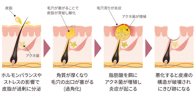 にきびができる原因