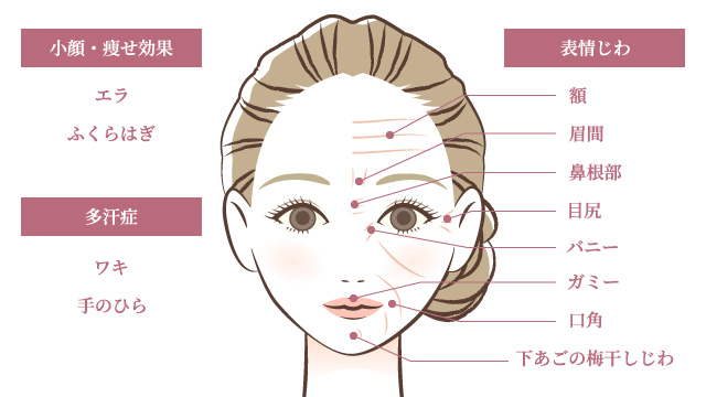 ボトックス注射の適応部位