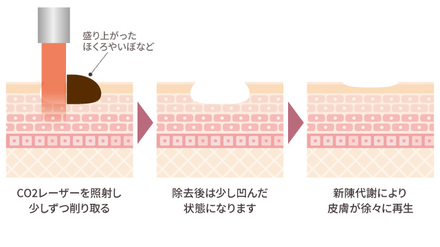 CO2レーザーのしくみ