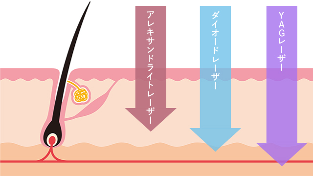 米国FDA承認のZEO(ゼオ)による施術