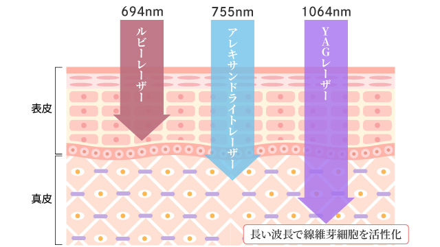 肌の深い層まで届くYAGレーザー