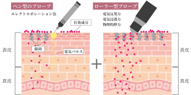 メソポレーション法の採用