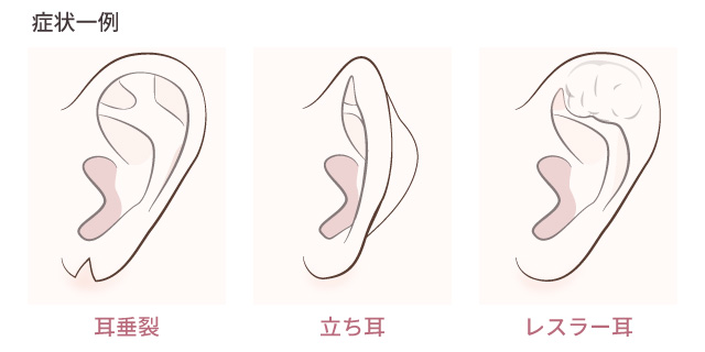 その他耳形成