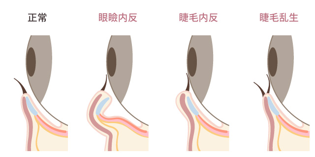 さかまつ毛修正