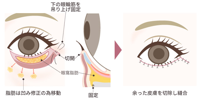 ハムラ法＋眼輪筋つり上げ