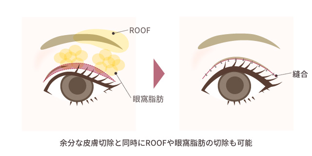 瞼縁皮膚切除