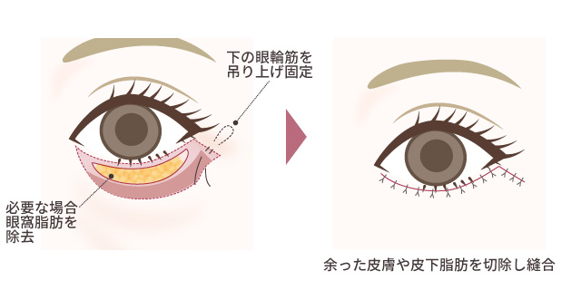 皮膚切除＋眼輪筋つり上げ