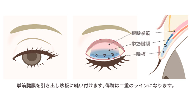 眼瞼下垂症手術