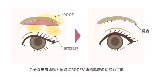 眉毛下皮膚切除