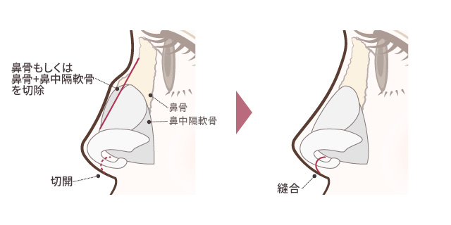 わし鼻修正(ハンプ切除)