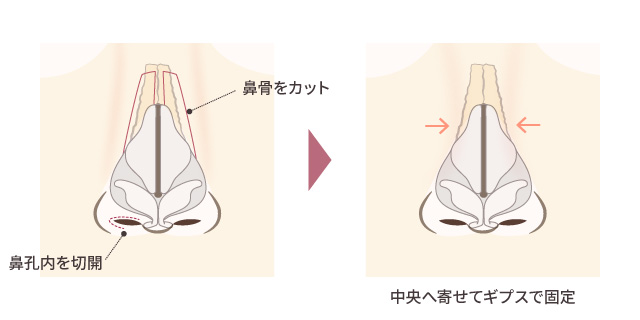 鼻骨骨切り