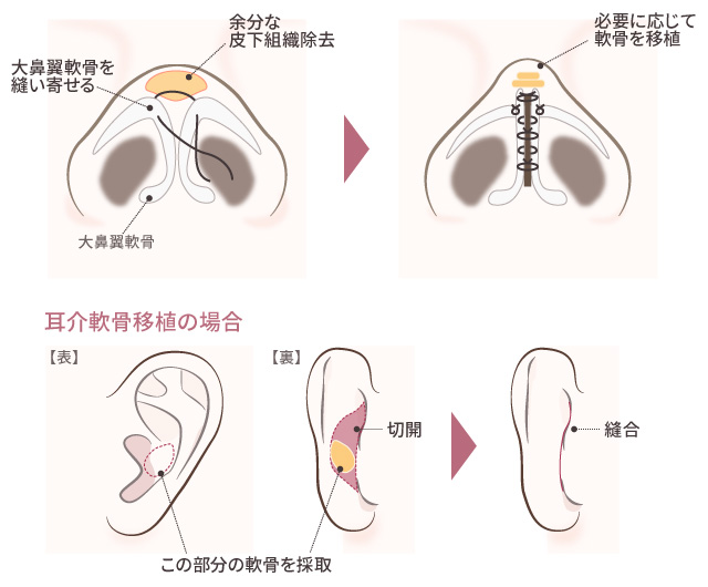 鼻尖形成術