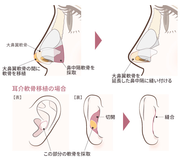 鼻中隔延長術