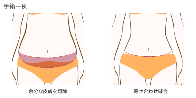 体重減少による皮膚弛緩症