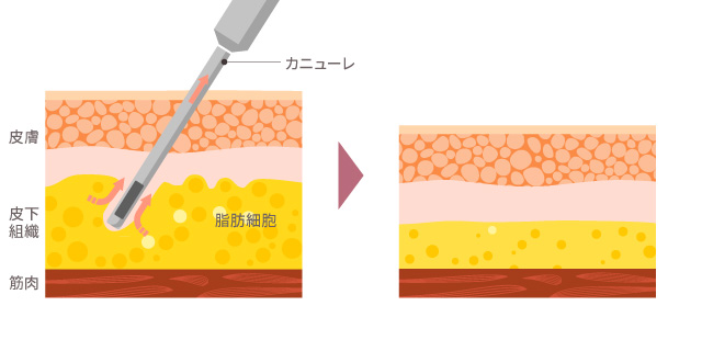 脂肪吸引