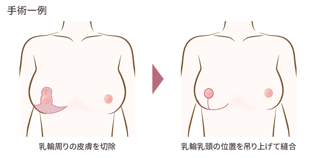 乳房つり上げ