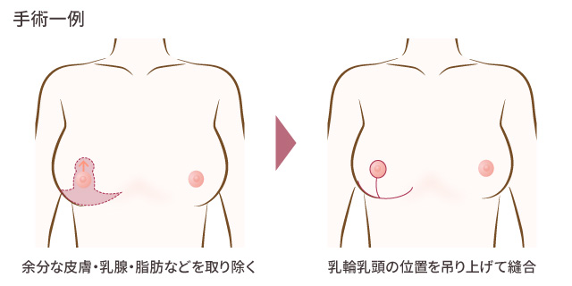 乳房縮小術