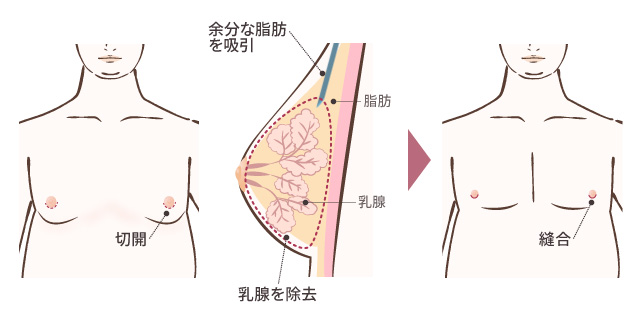 女性化乳房