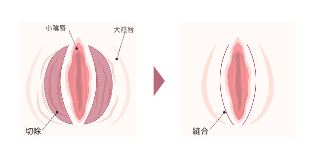 大陰唇増大