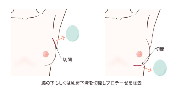 プロテーゼ抜去